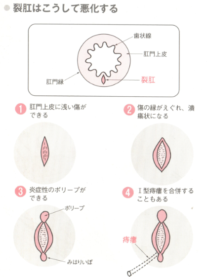 裂肛の悪化過程