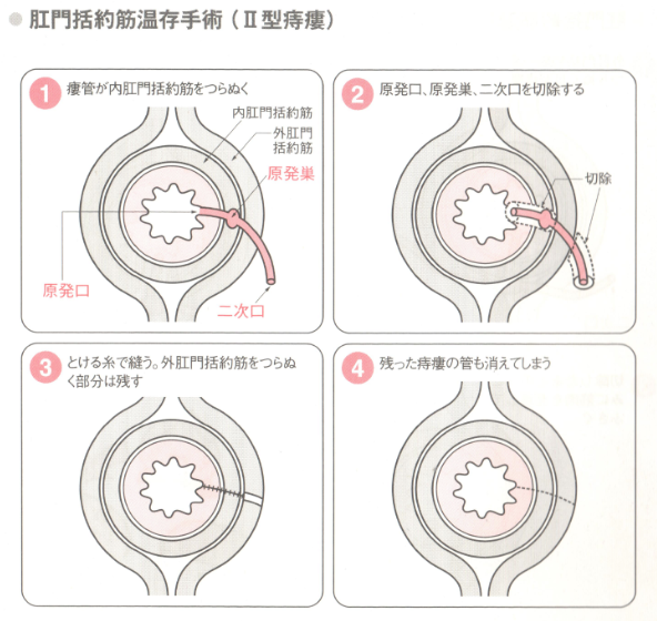 肛門括約筋温存手術(Ⅱ型痔瘻)