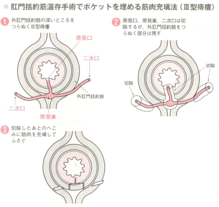 肛門括約筋温存手術筋肉充填法(Ⅲ型痔瘻)