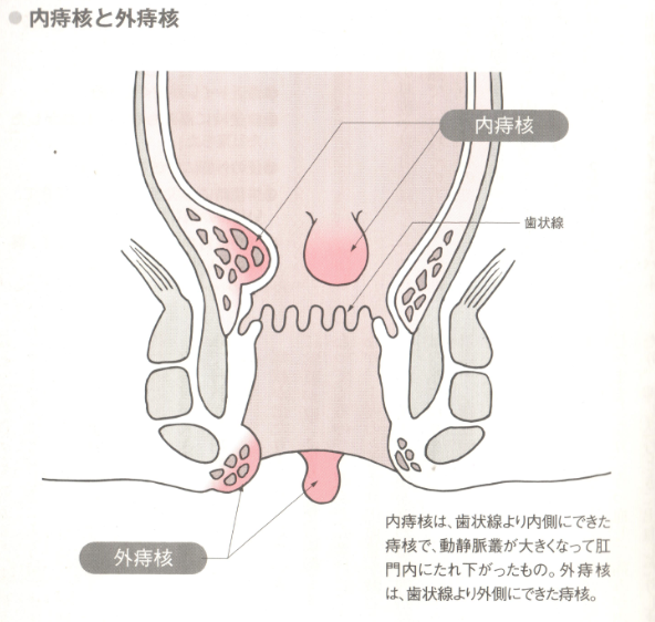 おしり の あな でき もの 痛く ない