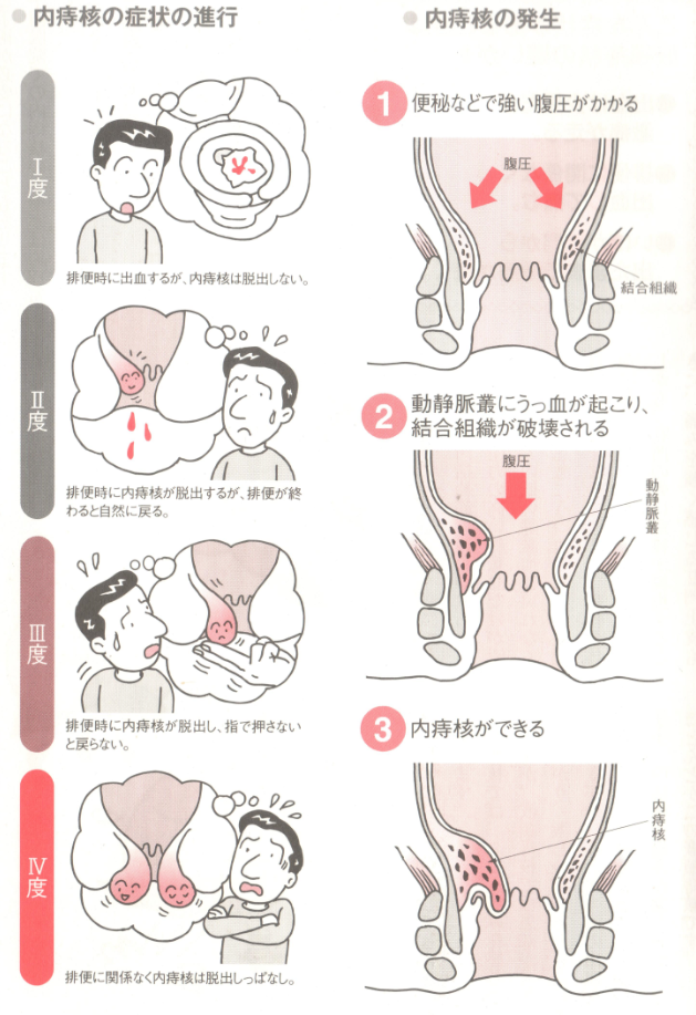 妊娠 中 切れ 痔