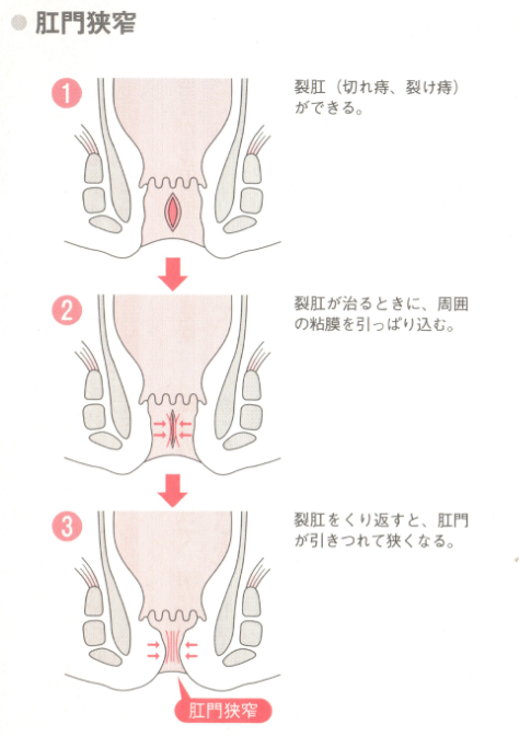 肛門狭窄 きょうさく 痔の治療なら 東京青山 平田肛門科医院